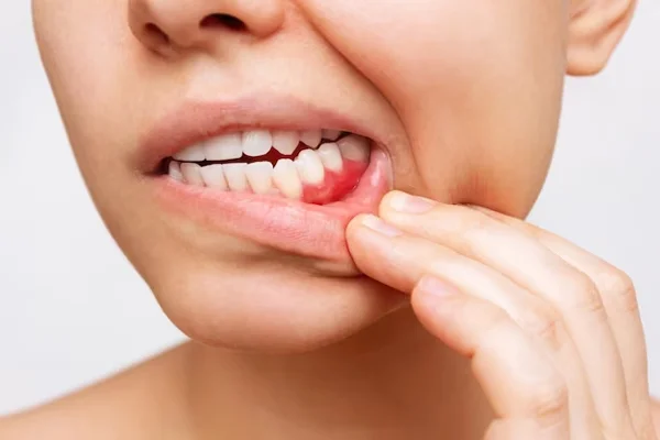 Pyorrhea Treatment
