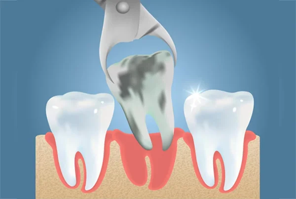 Wisdom Tooth Extraction