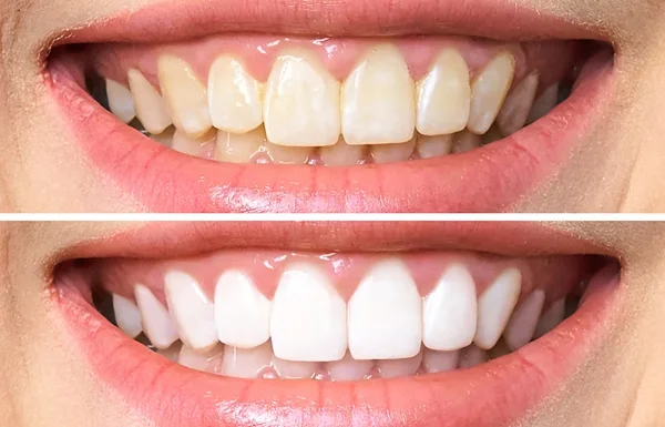 Teeth Whitening